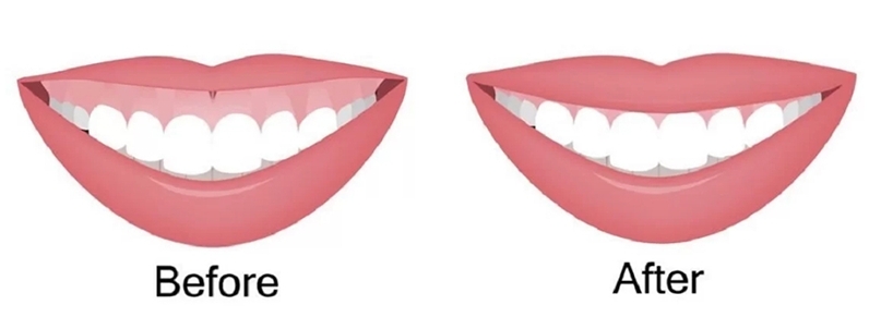 before and after gummy smile Botulinum Toxin